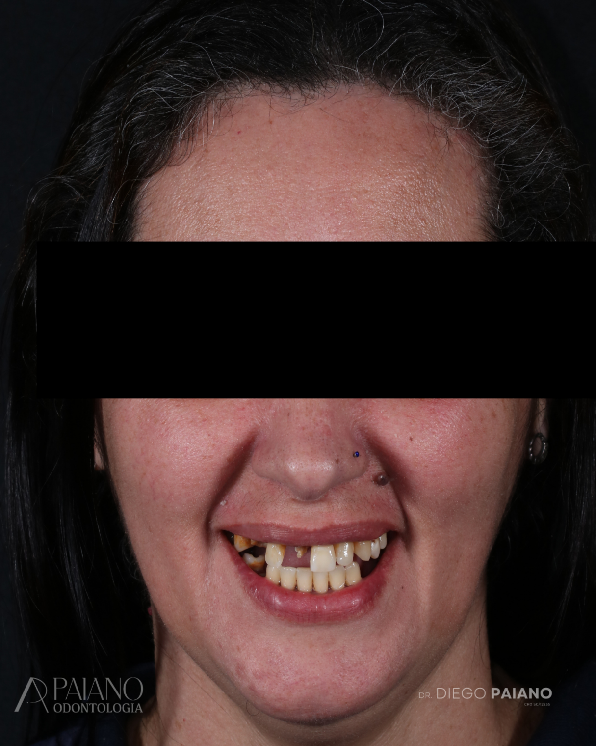 Antes do tratamento — paciente Paiano Odontologia