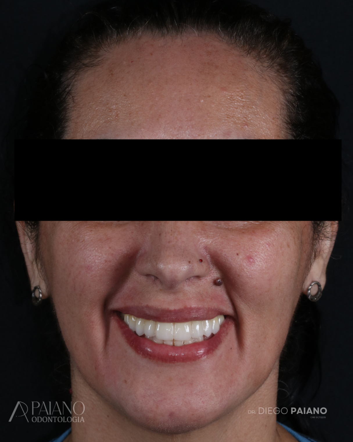 Depois do tratamento — paciente Paiano Odontologia